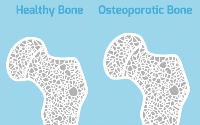 osteoporosis signs