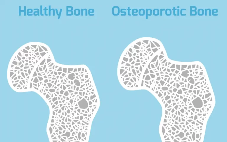 Osteoporosis Signs, Pain Relieving Therapies & Preventive Tips