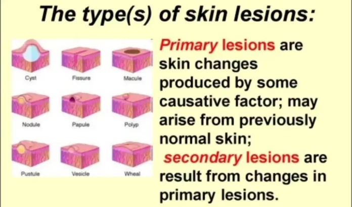 primary skin lessions