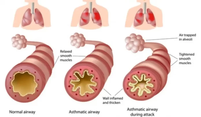 asthma vs copd