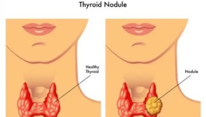 Benign Thyroid Nodules