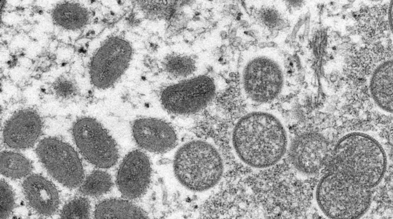Fourth Monkeypox Case Confirmed In Massachusetts
