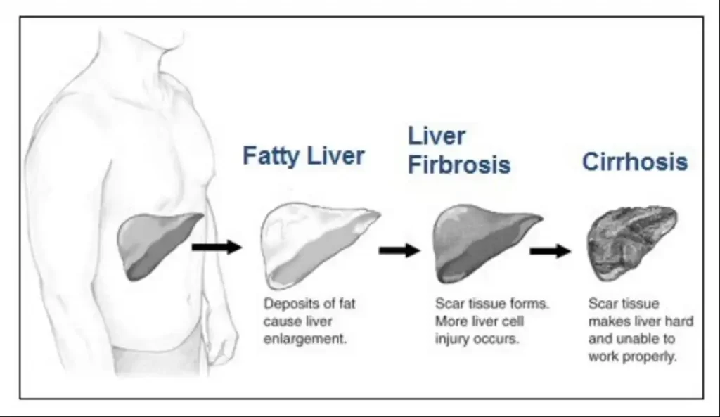 Non Alcoholic Fatty Liver Disease