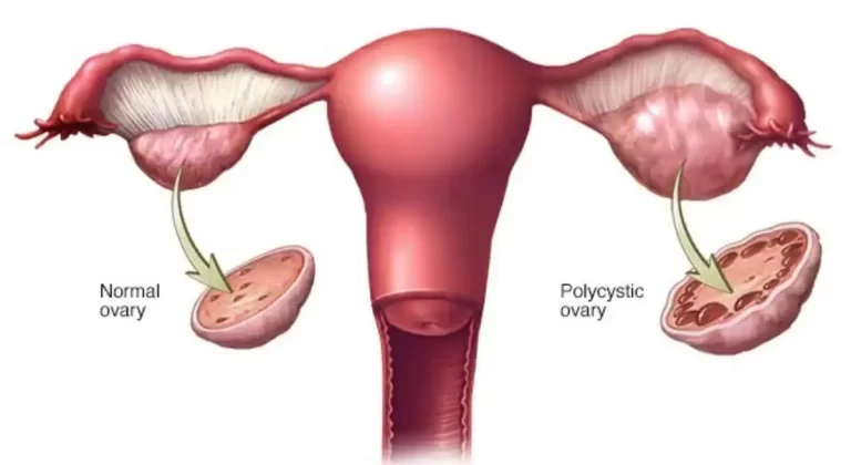 Pregnant Women With Polycystic Ovary Syndrome At Heart Disease Risk?
