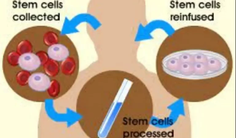 Stem Cell Treatment for Diabetes to Benefit Ailing Patients