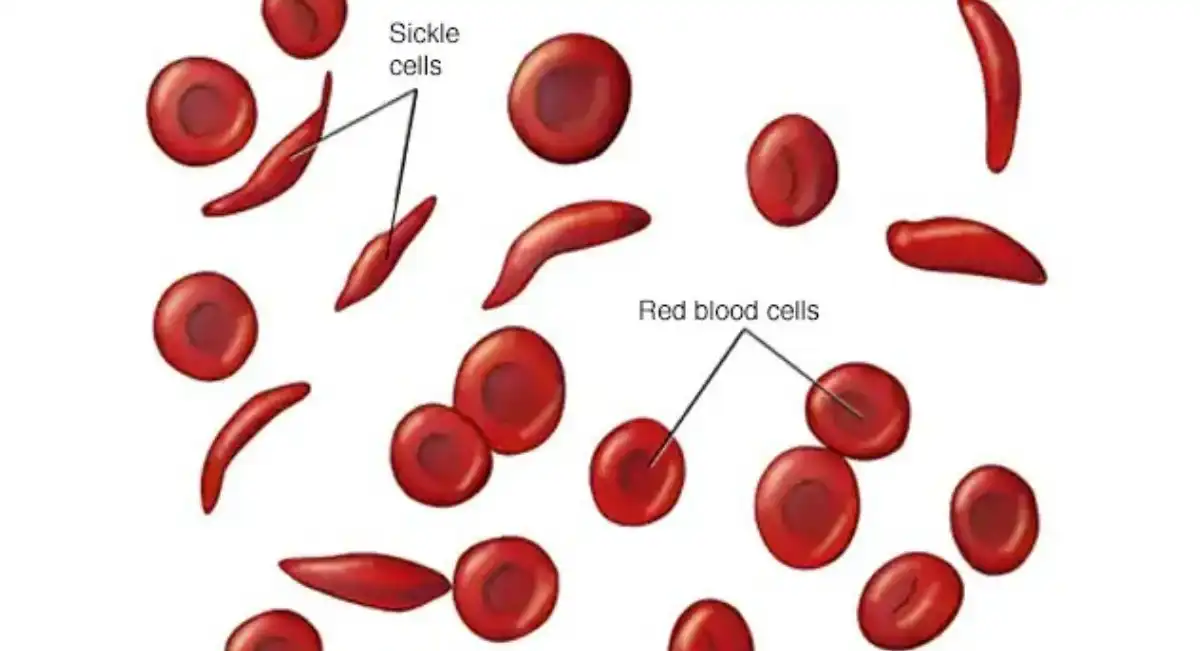 World Sickle Cell Day 2022
