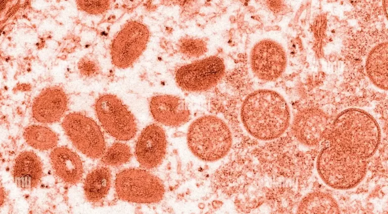 First Monkeypox Case In Fresno County Spotted