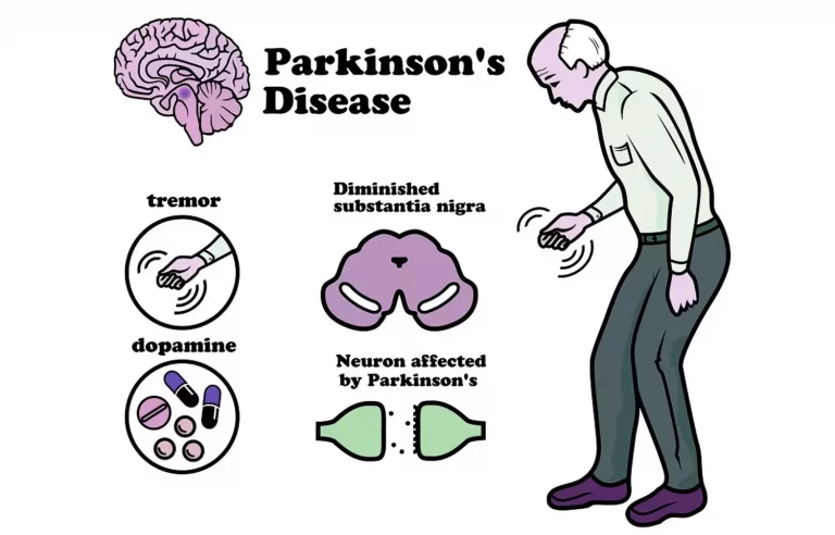 Treadmill Exercise Improves Symptoms of Parkinson’s Disease