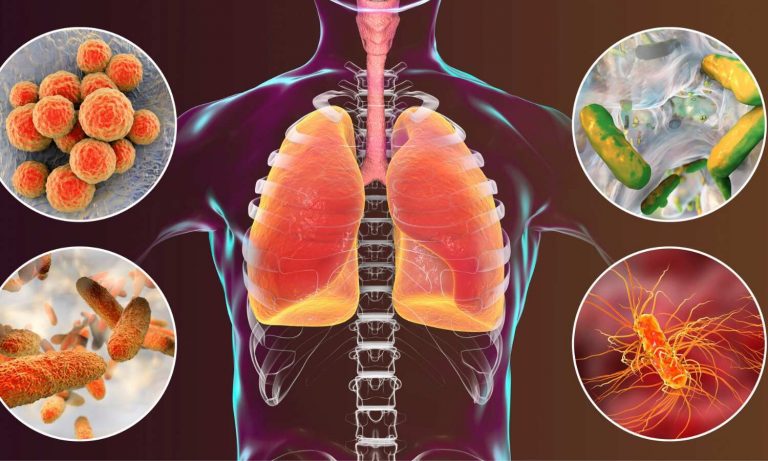 Study Finds Cystic Fibrosis Drug Helpful to Treat Pneumonia