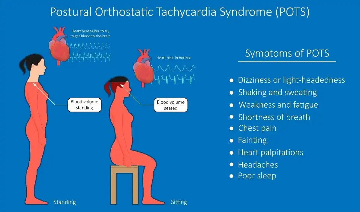 postural orthostatic tachycardia syndrome
